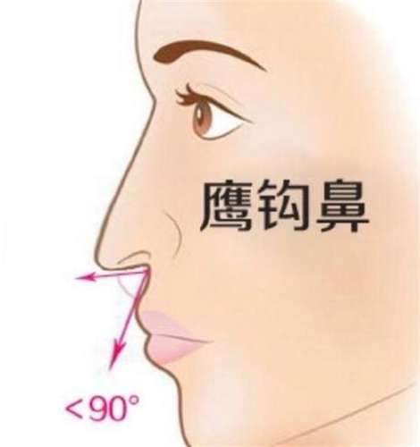 重庆西南医院做鼻子怎么样？隆鼻案例亲测分享！效果、价格收费标准戳戳