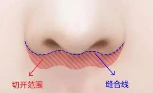 管果医生人中缩短案例分享，专家资料介绍，口碑评价一览